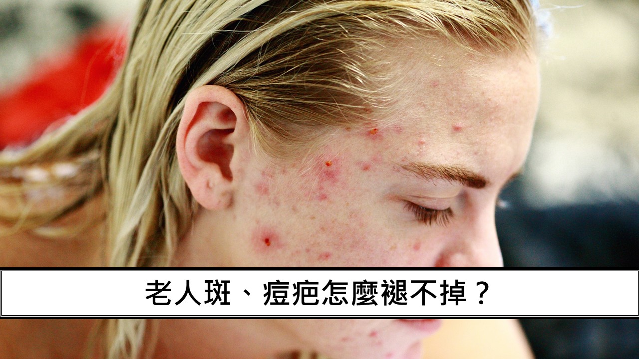 110_老人斑、痘疤怎麼褪不掉？