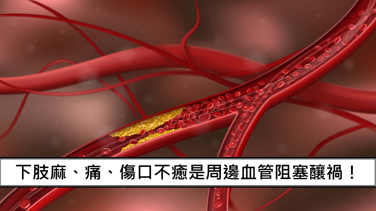 138_下肢麻、痛、傷口不癒是周邊血管阻塞釀禍！